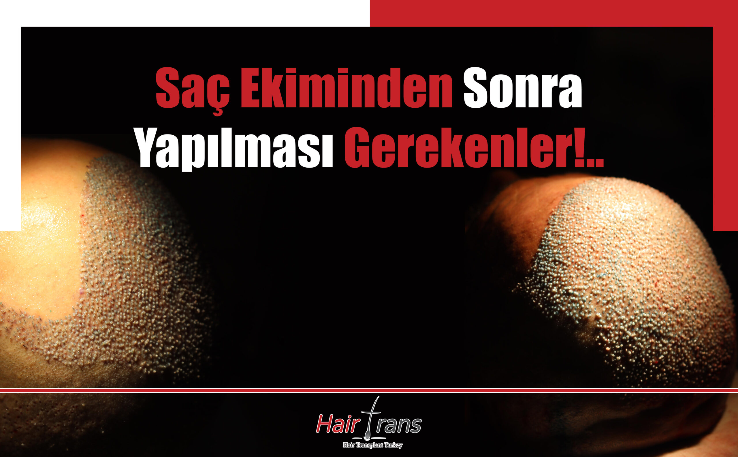 Saç Ekiminden Sonra Yapılması Gerekenler