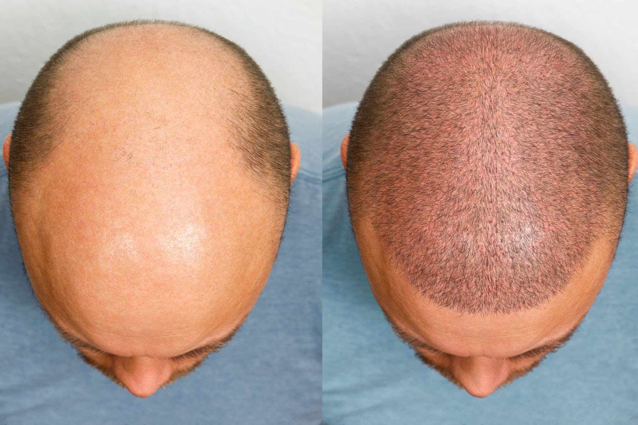 Trapianto di capelli in Turchia: servizio premium