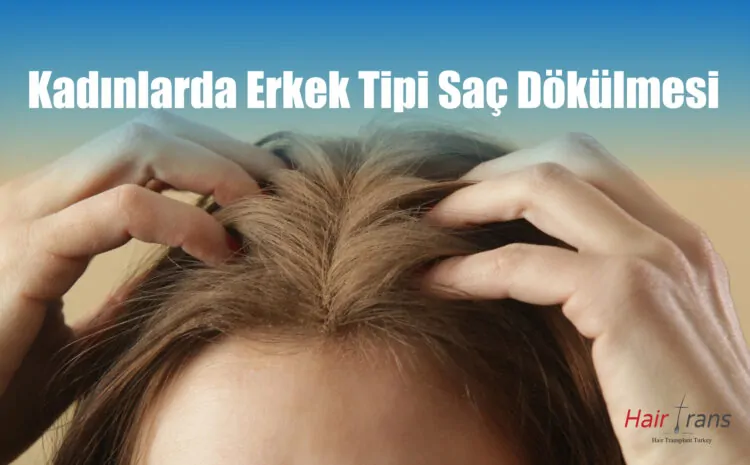 Erkek Tipi Saç Dökülmesi